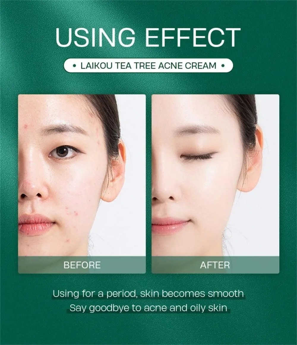 Laikou Tea Tree ACNE Cream-20gm - Image 4